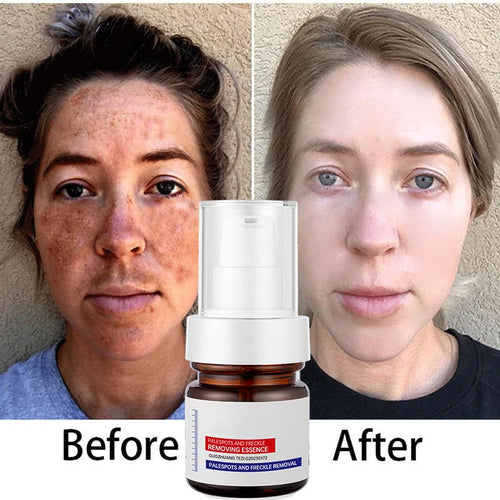 šćupgraded -40MLćErase Dark Spots in š„8 Seconds ā Kojic Acid & Vitamin C Brightening Serum for Instant Results