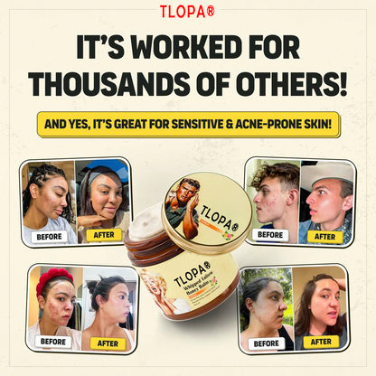 TLOPA®Natural facial cream - tallow cream and Manuka honey, removes acne, removes wrinkles, anti-oxidation!