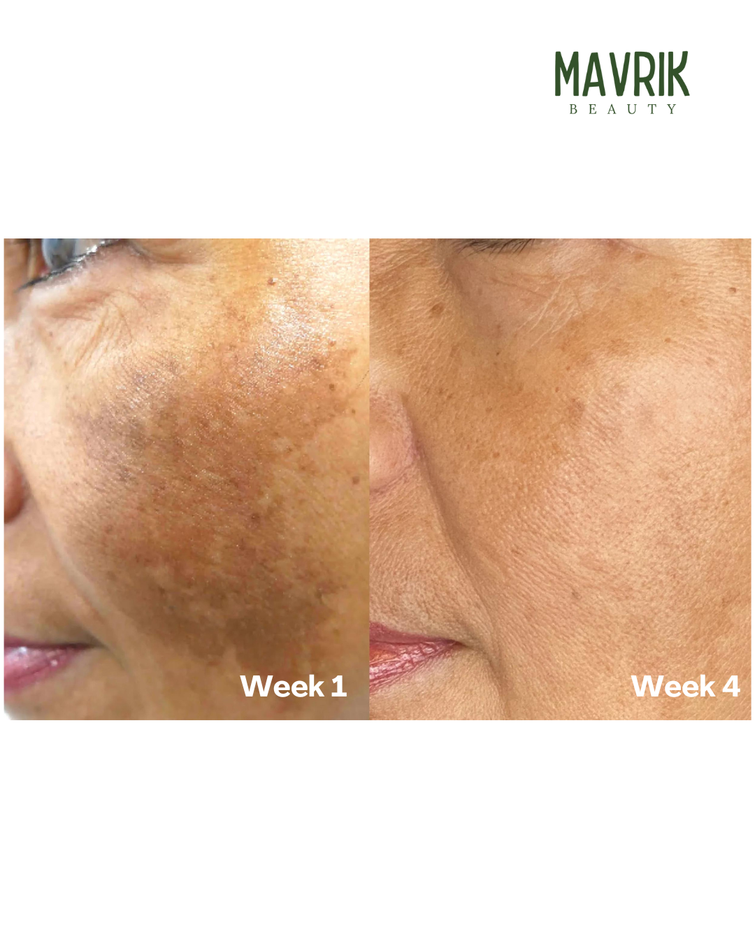 TLOPA® Turmeric & Kojic Acid Whitening Soap – Anti-Freckle, Brightening Formula, Visible Results in 2 Uses