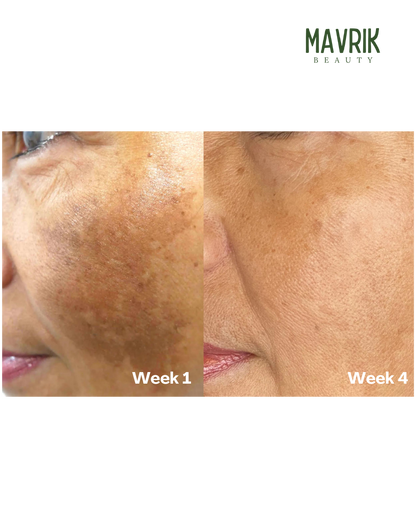 TLOPA® Turmeric & Kojic Acid Whitening Soap – Anti-Freckle, Brightening Formula, Visible Results in 2 Uses