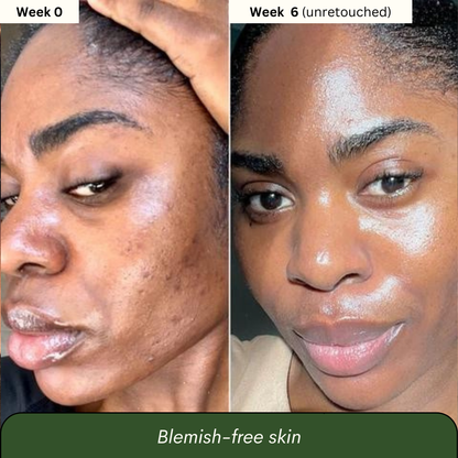 TLOPA® Turmeric & Kojic Acid Whitening Soap – Anti-Freckle, Brightening Formula, Visible Results in 2 Uses