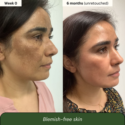 TLOPA® Turmeric & Kojic Acid Whitening Soap – Anti-Freckle, Brightening Formula, Visible Results in 2 Uses