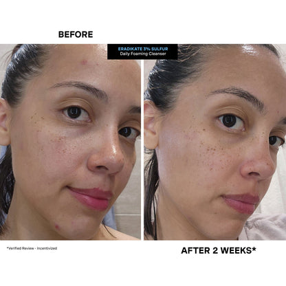 🏆TLOPA®  3% Sulfur Foaming Cleanser quickly fights acne and reveals a confident glow. 👩🏻‍⚕️【Dermatologist Recommended】